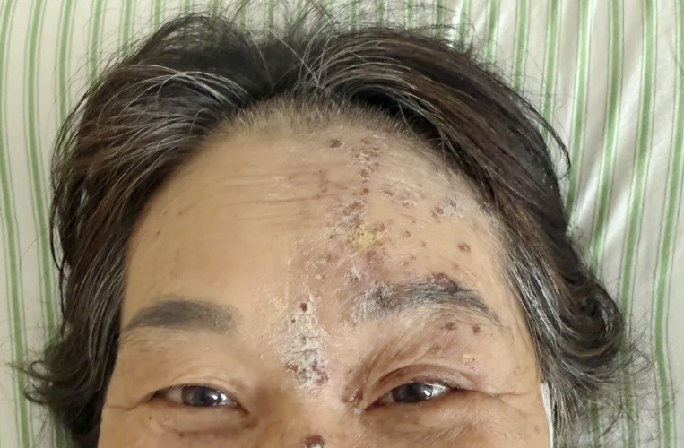 别以为“缠腰龙”只长在腰上!长在这个位置,风险极高,或致失明 别以为“缠腰龙”只长在腰上!长在这个位置,风险极高,或致失明