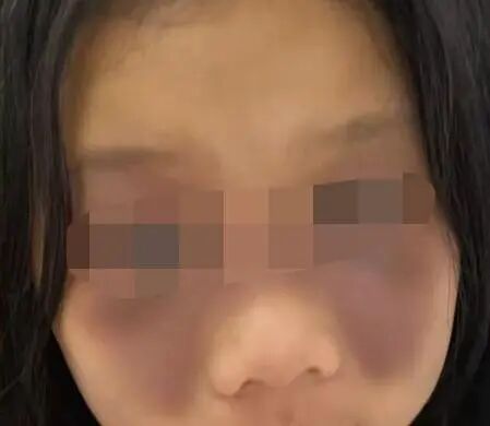 7岁女娃一觉醒来变成 “熊猫眼”,幕后黑手竟是家中常备药!医生紧急提醒 7岁女娃一觉醒来变成 “熊猫眼”,幕后黑手竟是家中常备药!医生紧急提醒
