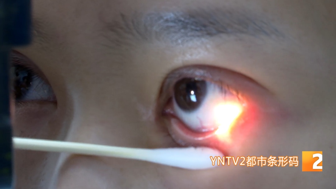 太吓人!昆明一24岁女子眼睛里爬出了活虫!医生取出5-6只后,第二天又有虫往外爬 太吓人!昆明一24岁女子眼睛里爬出了活虫!医生取出5-6只后,第二天又有虫往外爬
