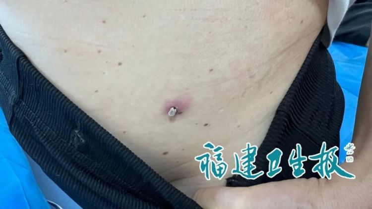 福建女子旅游归来,腰间多了颗“大痣”!医生一看惊呆:是活虫,严重可致死! 福建女子旅游归来,腰间多了颗“大痣”!医生一看惊呆:是活虫,严重可致死!