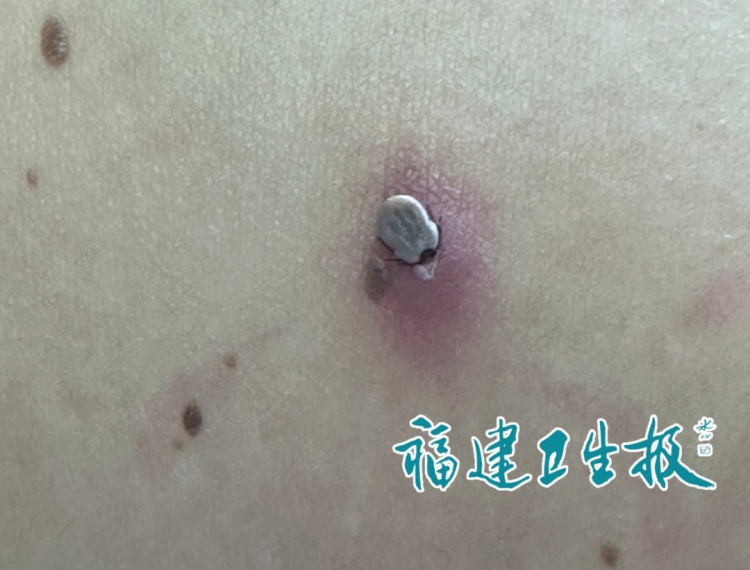 福建女子旅游归来,腰间多了颗“大痣”!医生一看惊呆:是活虫,严重可致死! 福建女子旅游归来,腰间多了颗“大痣”!医生一看惊呆:是活虫,严重可致死!