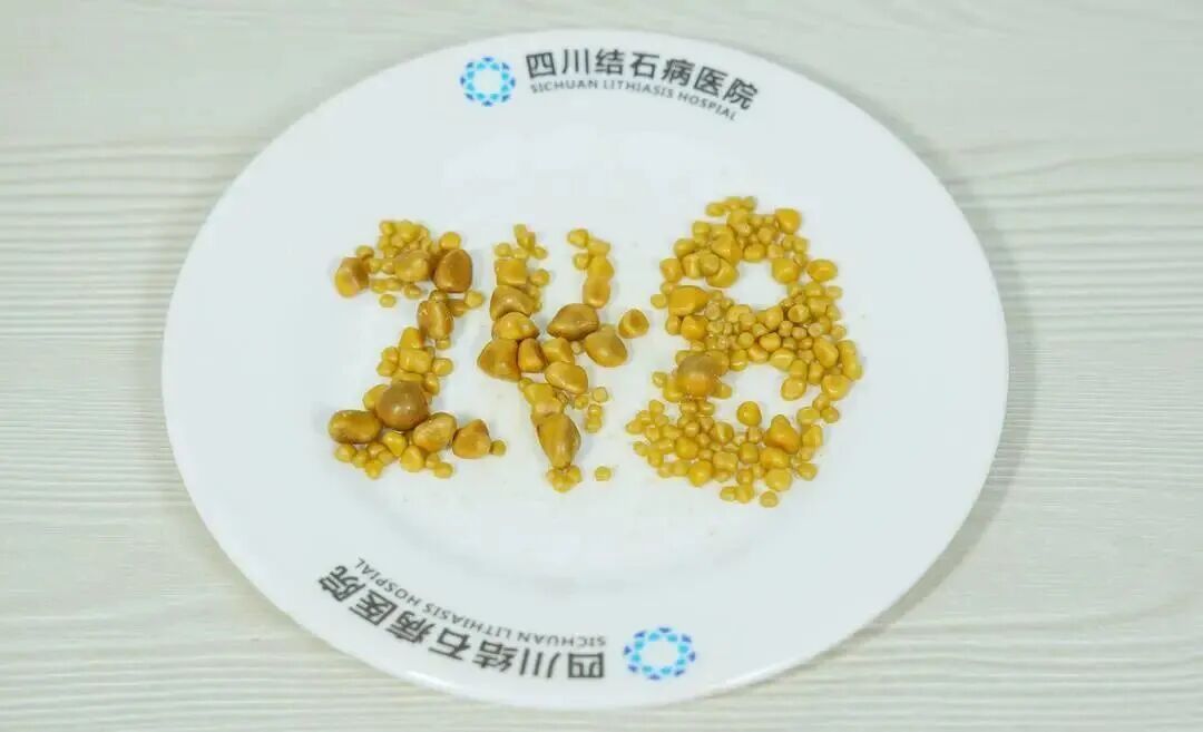 26岁小伙胆囊内取出248颗结石!这个坏习惯很多人都有,医生提醒→ 26岁小伙胆囊内取出248颗结石!这个坏习惯很多人都有,医生提醒→