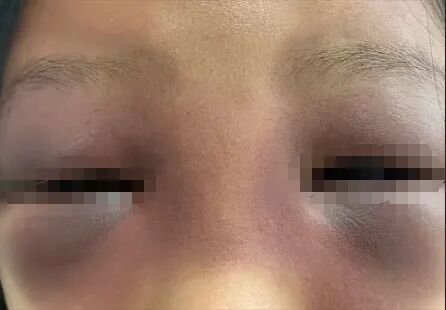 7岁女娃一觉醒来变成 “熊猫眼”,幕后黑手竟是家中常备药!医生紧急提醒 7岁女娃一觉醒来变成 “熊猫眼”,幕后黑手竟是家中常备药!医生紧急提醒