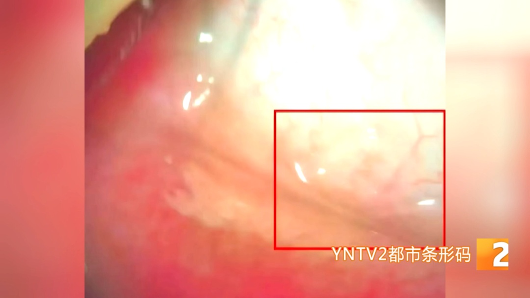太吓人!昆明一24岁女子眼睛里爬出了活虫!医生取出5-6只后,第二天又有虫往外爬 太吓人!昆明一24岁女子眼睛里爬出了活虫!医生取出5-6只后,第二天又有虫往外爬