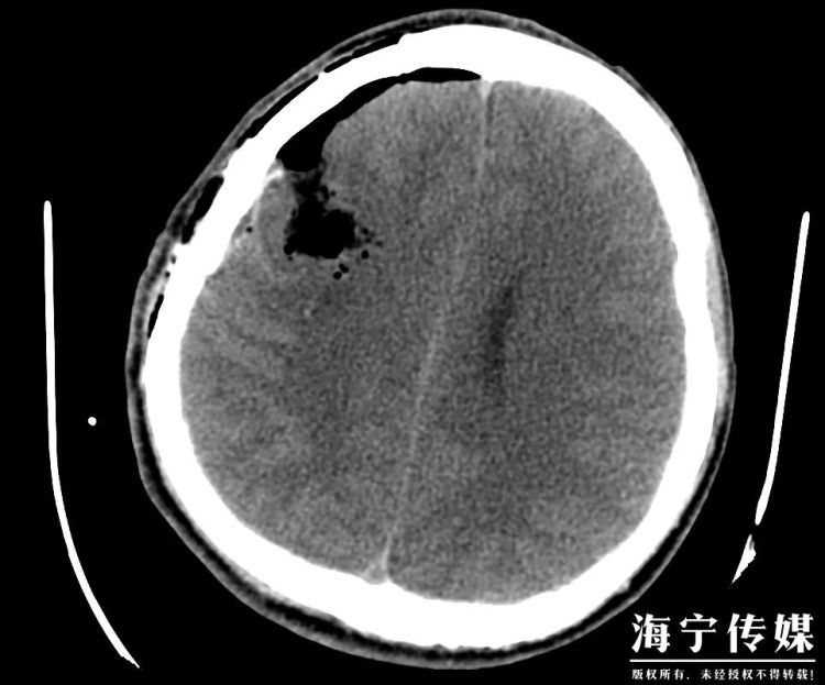 “年纪轻轻,不沾烟酒,就偏瘫?”23岁小伙上班时突然昏倒,原因竟是…… “年纪轻轻,不沾烟酒,就偏瘫?”23岁小伙上班时突然昏倒,原因竟是……