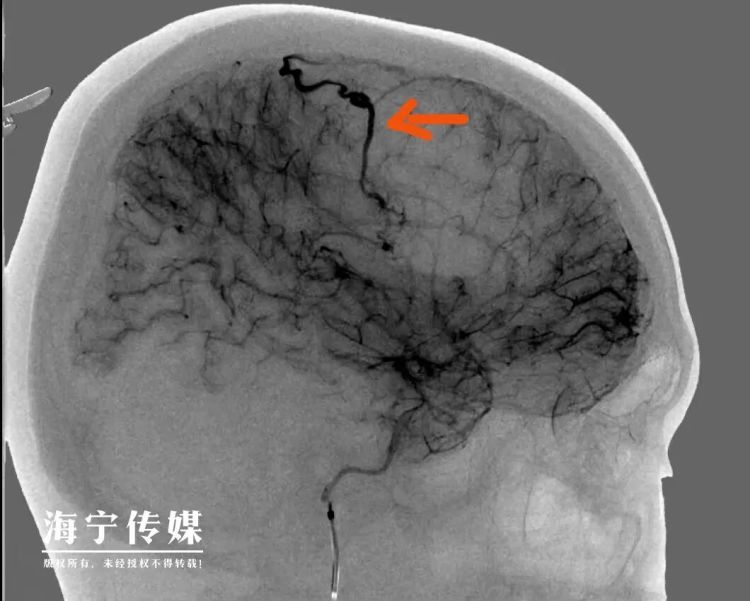 “年纪轻轻,不沾烟酒,就偏瘫?”23岁小伙上班时突然昏倒,原因竟是…… “年纪轻轻,不沾烟酒,就偏瘫?”23岁小伙上班时突然昏倒,原因竟是……