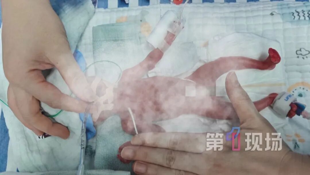深圳一婴儿早产116天,仅330克,脚掌比成人拇指还小!105天完成生命“闯关” 深圳一婴儿早产116天,仅330克,脚掌比成人拇指还小!105天完成生命“闯关”