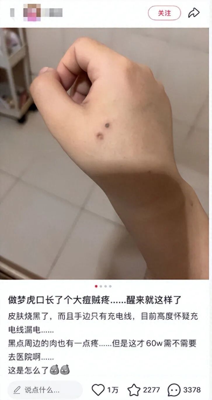 被充电线漏电烧伤要查心脏?医生:绝非小题大做,电击后3天是高风险期 被充电线漏电烧伤要查心脏?医生:绝非小题大做,电击后3天是高风险期