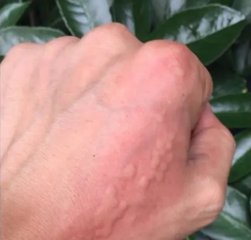 剧痛!近期这种毒虫频现,千万别碰 剧痛!近期这种毒虫频现,千万别碰