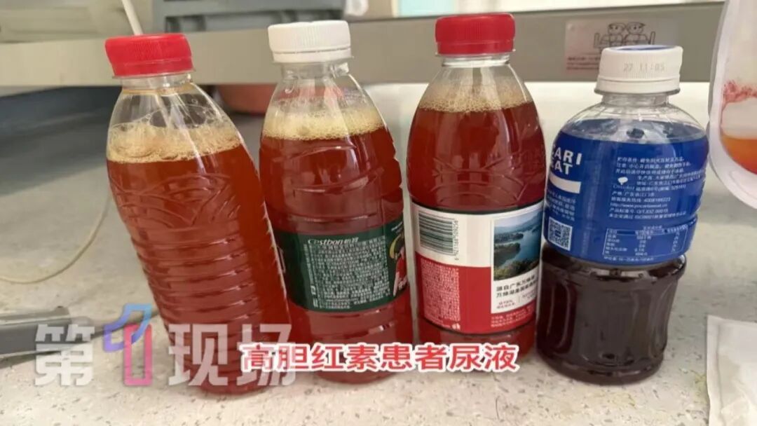 深圳男子尿液变成血红色！医生：想保命，需要“切除”五个器官