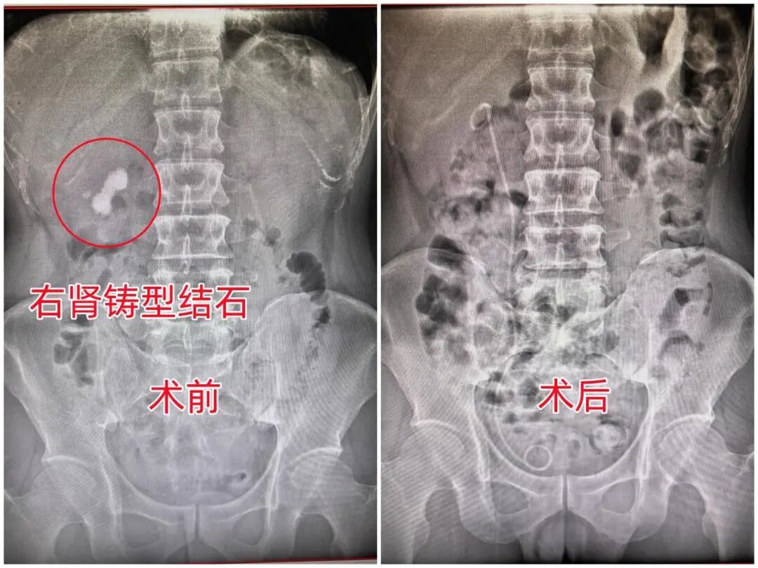 男子腰痛靠药物“扛”两年,就医才知右肾长出铸型结石 男子腰痛靠药物“扛”两年,就医才知右肾长出铸型结石