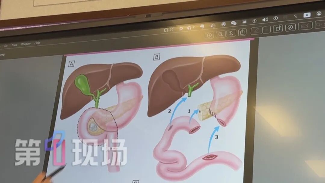 深圳男子尿液变成血红色！医生：想保命，需要“切除”五个器官