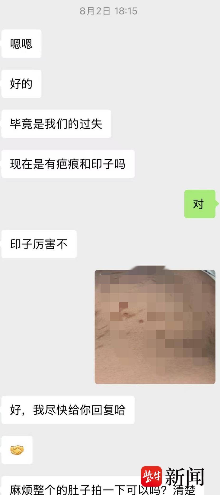 18岁女生在美容院“瘦腰”致皮肤损伤，数十条炎症印记与瘢痕九个月未消，卫健委回应：已介入处理