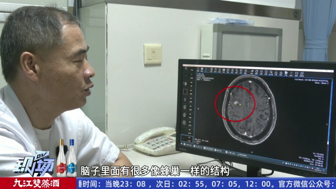 56岁女子脸歪无力9年，不是中风不是肿瘤！真凶竟是脑子里的一条活虫
