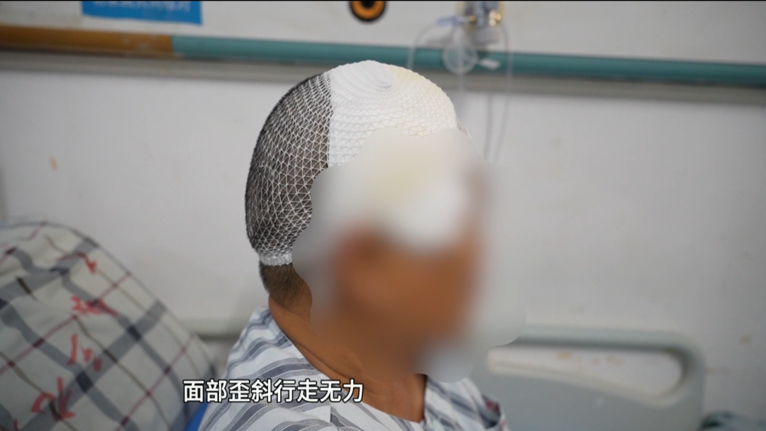 56岁女子脸歪无力9年，不是中风不是肿瘤！真凶竟是脑子里的一条活虫