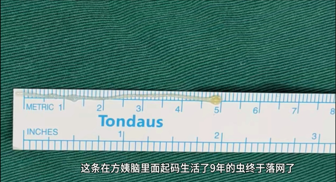 56岁女子脸歪无力9年，不是中风不是肿瘤！真凶竟是脑子里的一条活虫