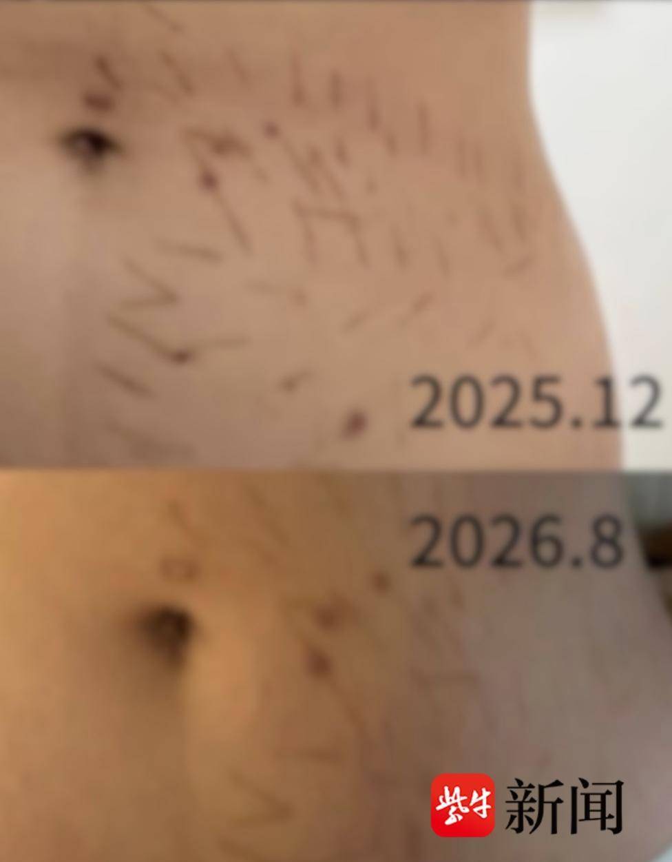 18岁女生在美容院“瘦腰”致皮肤损伤，数十条炎症印记与瘢痕九个月未消，卫健委回应：已介入处理