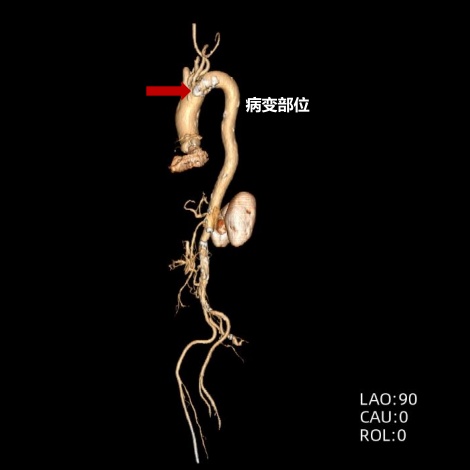 广东101岁大爷血管里长出溃疡，医生从大腿根伸根管子补好了，术后第二天即可进食