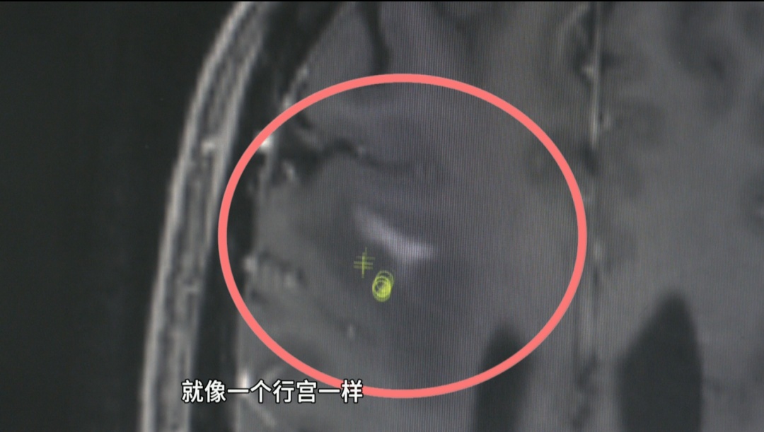 56岁女子脸歪无力9年，不是中风不是肿瘤！真凶竟是脑子里的一条活虫