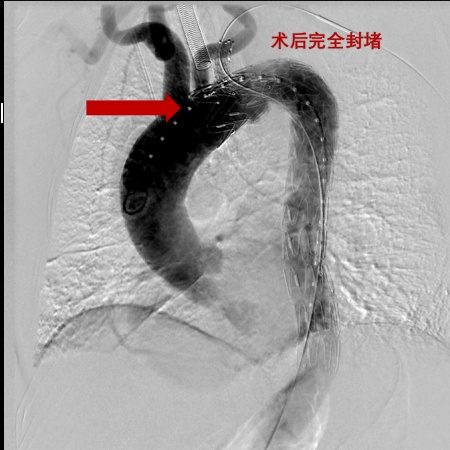 广东101岁大爷血管里长出溃疡，医生从大腿根伸根管子补好了，术后第二天即可进食