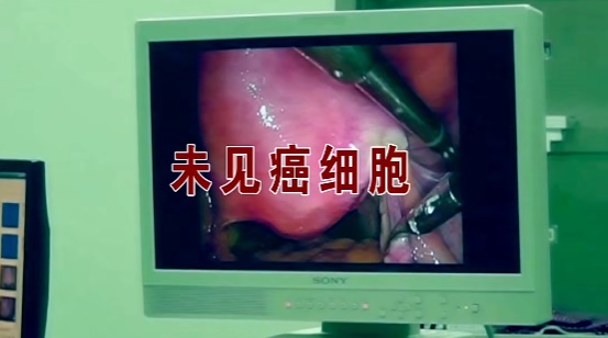 一男子肚子疼被诊断为“胃癌”切除整个胃，化验结果却显示没有癌细胞，法院判了！