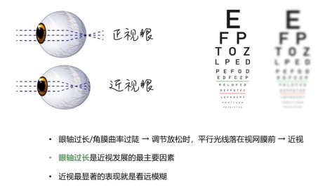 那些戴OK镜治疗近视的人，后来怎样了？