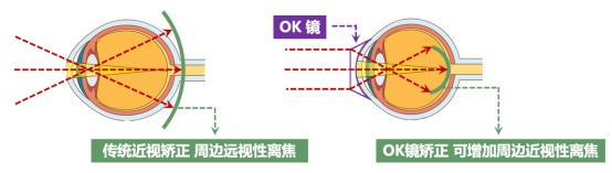 那些戴OK镜治疗近视的人，后来怎样了？