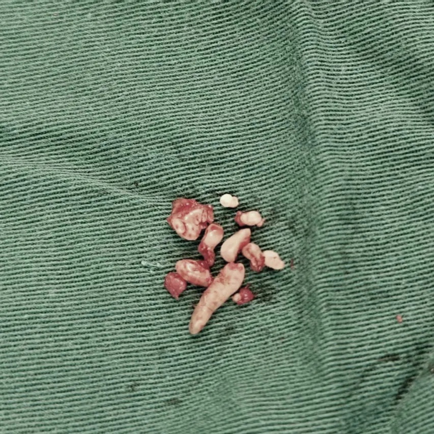 浙江一女子总是牙疼!做CT一查,牙齿里密密麻麻全是... 浙江一女子总是牙疼!做CT一查,牙齿里密密麻麻全是...