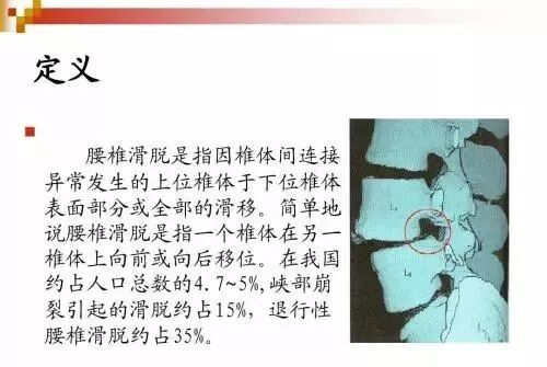 演员陈赫已暂停部分工作!自曝确诊严重腰椎滑脱 演员陈赫已暂停部分工作!自曝确诊严重腰椎滑脱