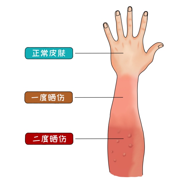 医点通丨长时间户外训练,小心“日晒伤”! 医点通丨长时间户外训练,小心“日晒伤”!