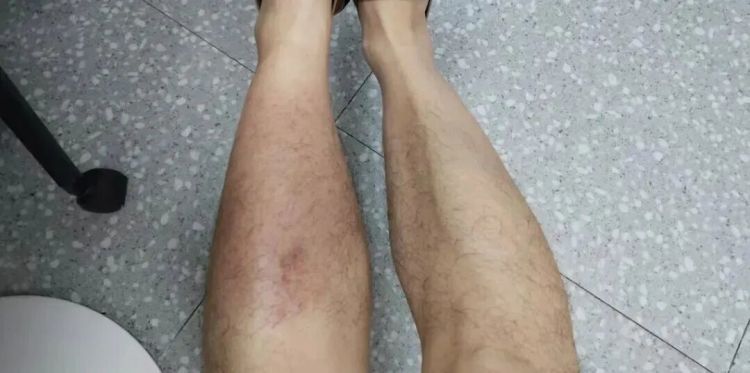 男子腿肿成“猪蹄”,这个癖好有点“毒”!两类人最易中招,严重可致败血症 男子腿肿成“猪蹄”,这个癖好有点“毒”!两类人最易中招,严重可致败血症