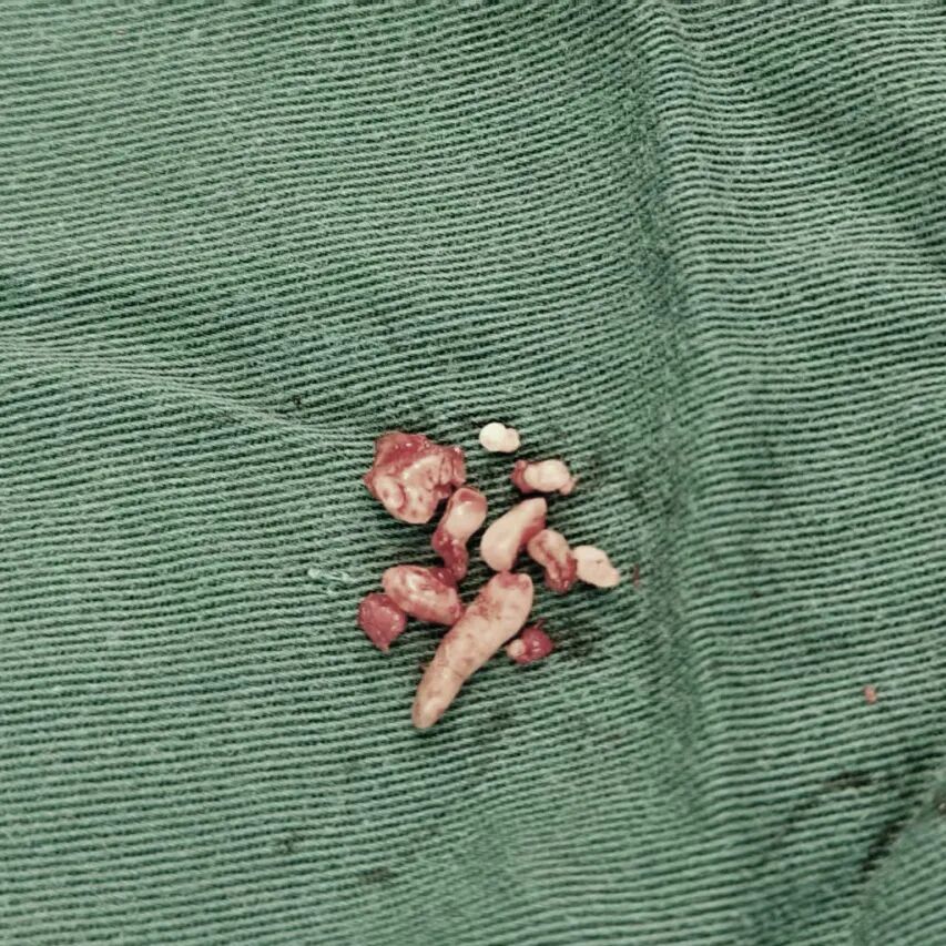 女子总是牙疼,做CT一查,牙齿里密密麻麻全是“牙瘤”!医生:难以准确预防 女子总是牙疼,做CT一查,牙齿里密密麻麻全是“牙瘤”!医生:难以准确预防