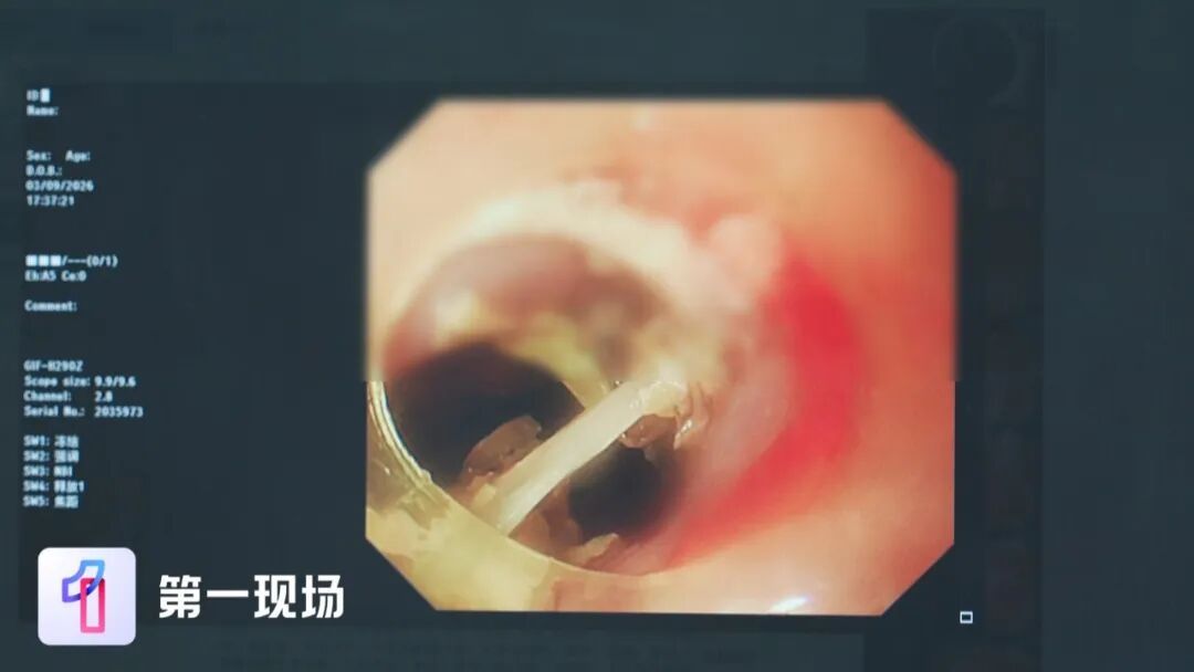 男子误吞鱼骨,自配“化骨水” ,饮用后鱼骨反而刺穿食管壁…… 男子误吞鱼骨,自配“化骨水” ,饮用后鱼骨反而刺穿食管壁……