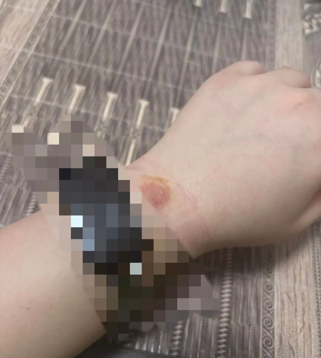 男子被智能手环“烫伤”皮肤?专家提醒:警惕过敏和长期的温热刺激 男子被智能手环“烫伤”皮肤?专家提醒:警惕过敏和长期的温热刺激