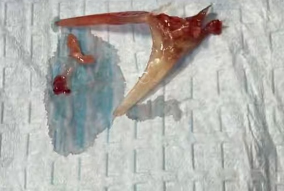 男子误吞鱼骨,自配“化骨水” ,饮用后鱼骨反而刺穿食管壁…… 男子误吞鱼骨,自配“化骨水” ,饮用后鱼骨反而刺穿食管壁……