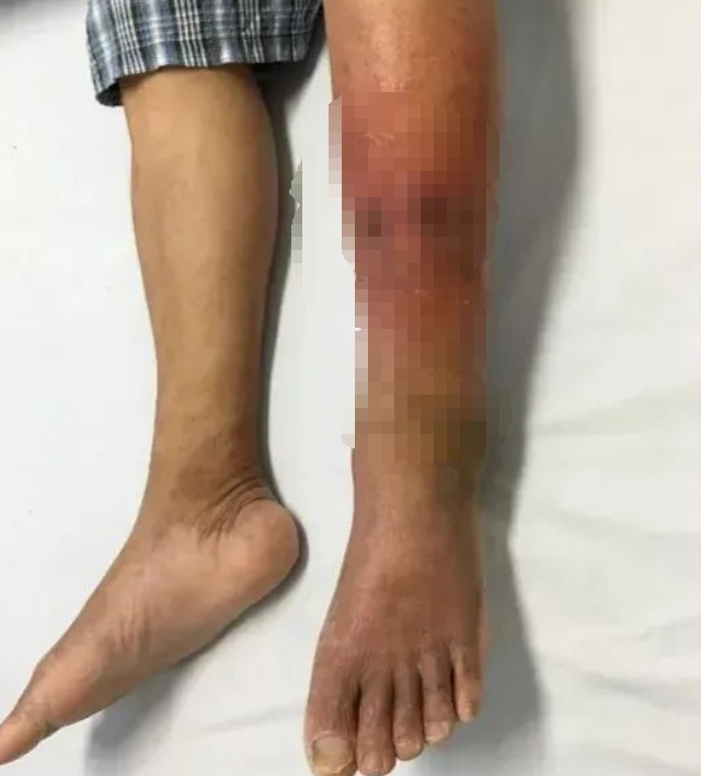 爱抠脚、抠鼻子的人注意了,这个癖好有点“毒”,已接连有人中招,严重可致败血症 爱抠脚、抠鼻子的人注意了,这个癖好有点“毒”,已接连有人中招,严重可致败血症