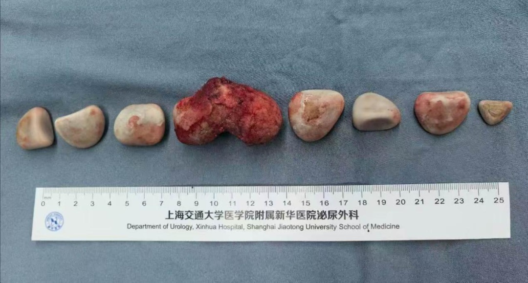 太痛苦!沪一男子受外伤后长期尿失禁!医生手术取出8颗石头 太痛苦!沪一男子受外伤后长期尿失禁!医生手术取出8颗石头