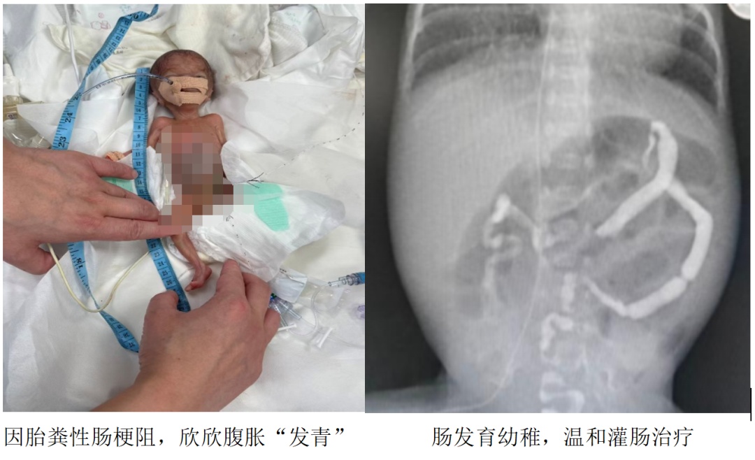 108天，330克，刷新救治纪录！广东一医院成功救治超低出生体重早产儿
