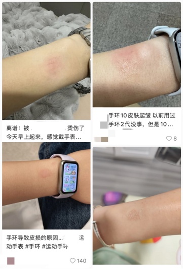 智能手表真的会损伤皮肤吗?皮肤科专家提醒 智能手表真的会损伤皮肤吗?皮肤科专家提醒