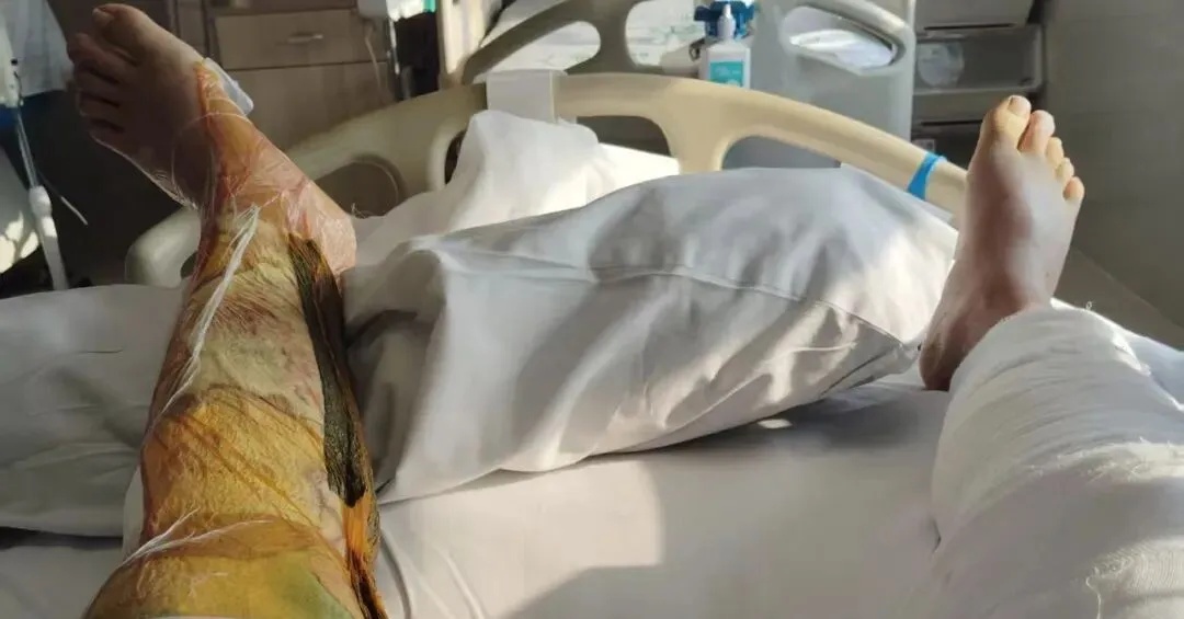 因加油时一个动作，男子开车驶离15分钟后突然起火，致终身伤残！紧急提醒