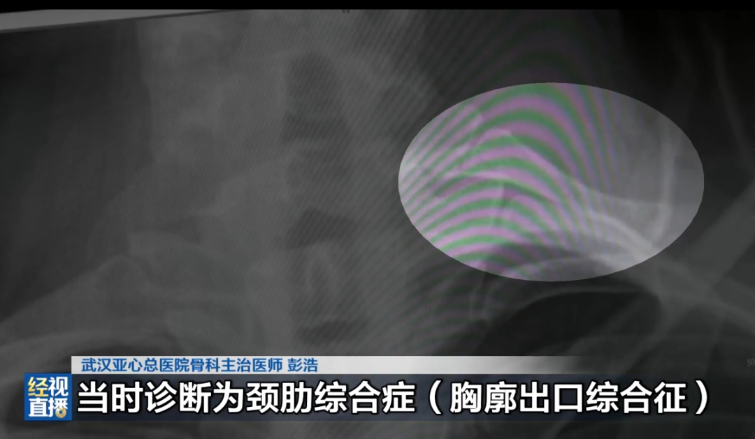 武汉女子脖子一动就像“触电”一样，被折磨一整年！医生：脖子多长出了一根肋骨