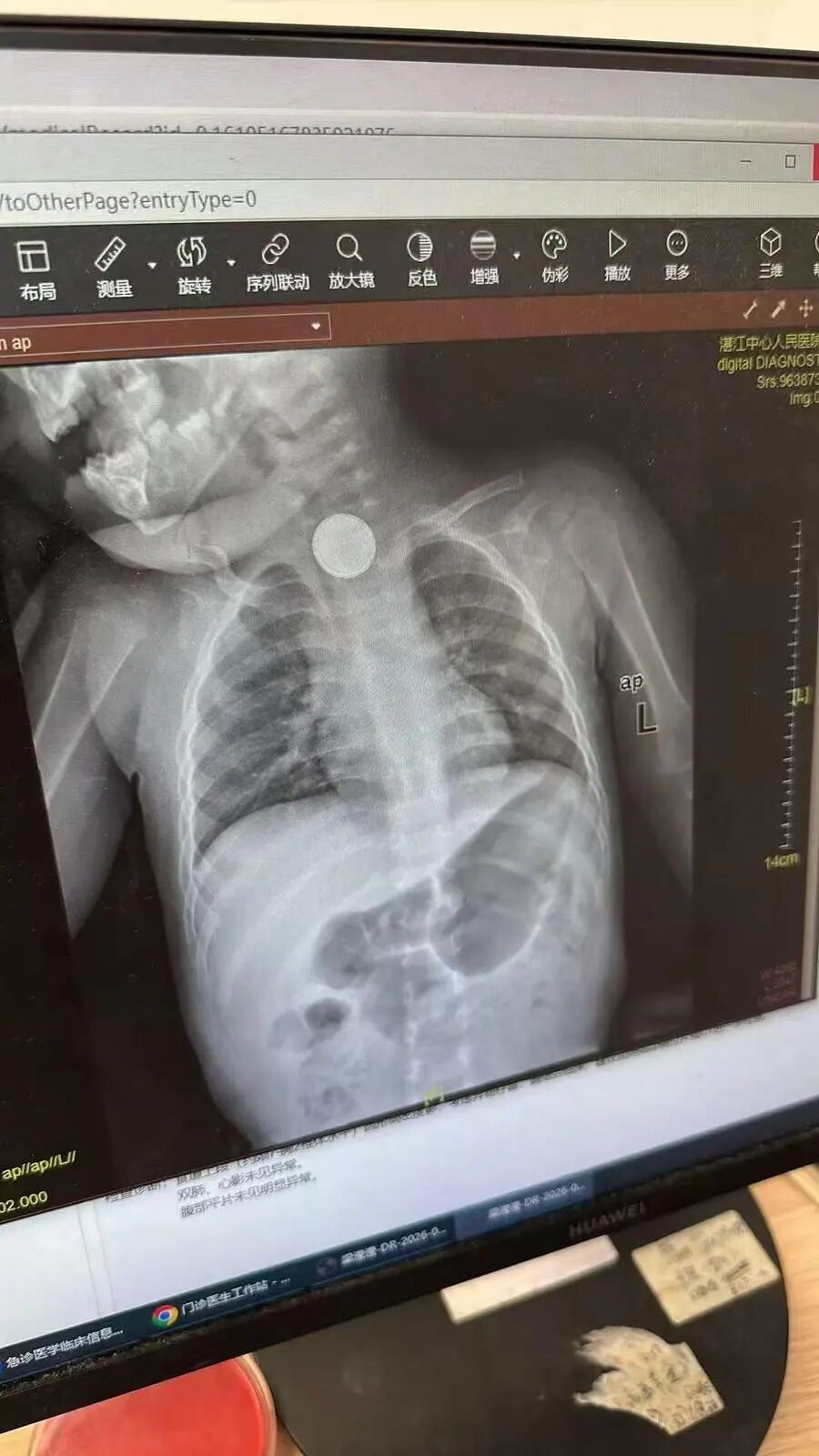 女婴误吞纽扣电池，26小时后才发现！食道被严重腐蚀