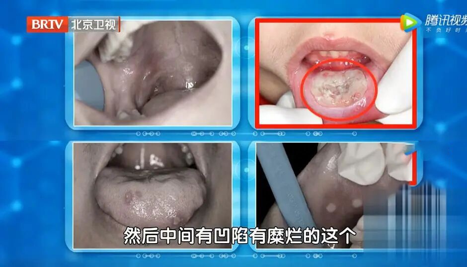 一口下肚，咽喉糜烂，险些窒息丧命，这种东西不能直接吃，很多人还不知道