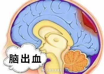 50%脑出血患者有先兆症状