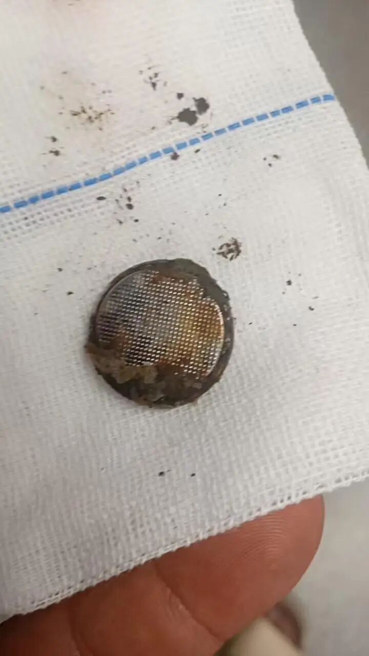 女婴误吞纽扣电池，26小时后才发现！食道被严重腐蚀