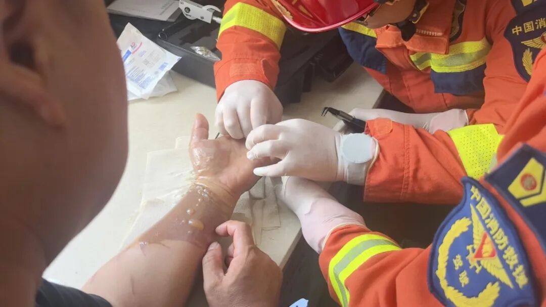 饭没做成反被烫,男子左手“爬满”水泡,无名指上的TA还在持续“加刑” 饭没做成反被烫,男子左手“爬满”水泡,无名指上的TA还在持续“加刑”