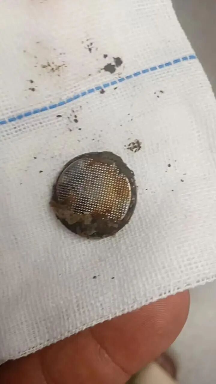 16个月女童误吞电池！26小时后才送医，食道已严重腐烂灼伤