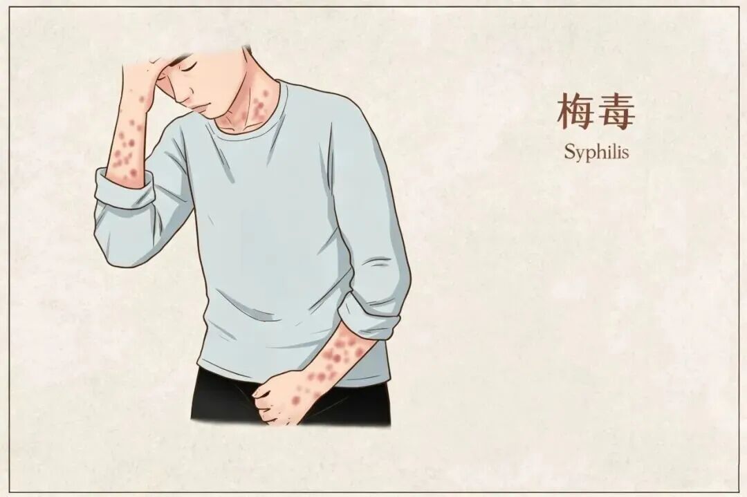 日本梅毒感染扩散！上海疾控：为什么是日本？如何识别预防？