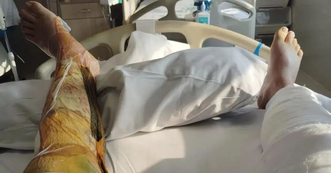 男子加油时一个举动,导致自己终身伤残,加油站赔偿约24.5万元!很多人都有这个误区 男子加油时一个举动,导致自己终身伤残,加油站赔偿约24.5万元!很多人都有这个误区
