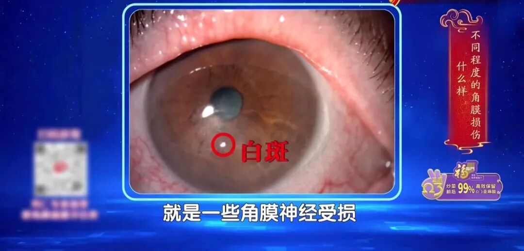 一个毁掉视力的习惯，你可能天天做，两个小动作帮你减少眼部损伤